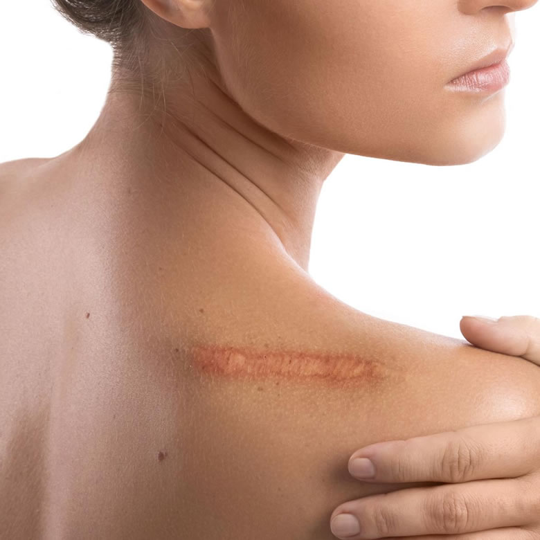 Tratamento de cicatrizes na pele
